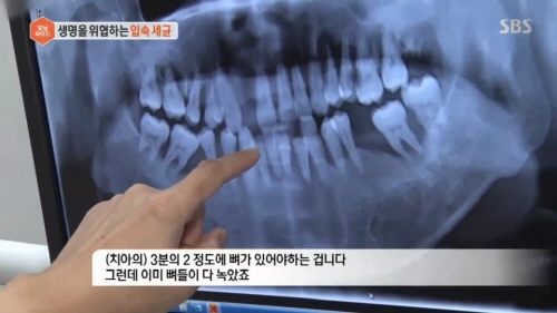 평소 관리해도 생기는 충치, 유전자 탓? “구강청결제 사용하세요”
