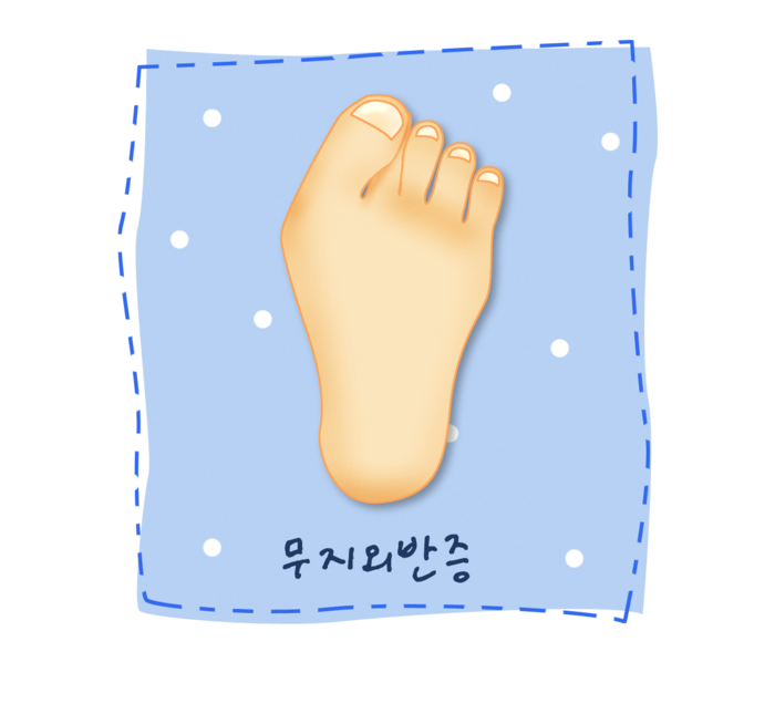 여름 철 못난 발 콤플렉스, 무지외반증•망치족지 극복 팁