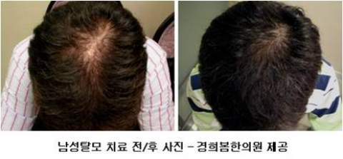 성공취업 위해 탈모치료 결심하는 남성 늘어